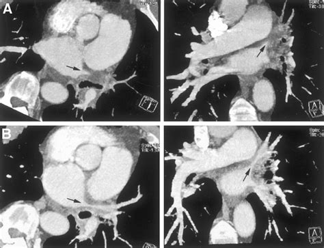 Transcatheter Angioplasty for Acquired Pulmonary Vein Stenosis After ...