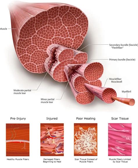 Healing a Pulled Muscle: Pain, Swelling & Limited Mobility - El Paso, TX Doctor Of Chiropractic