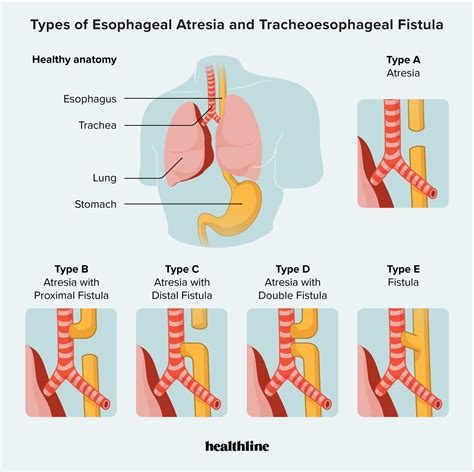 Tracheoesophageal Fistula: Causes, Symptoms, Diagnosis, Treatment