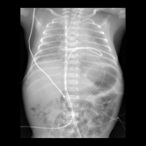 Umbilical Venous Catheter Malfunction / Malposition / Misposition ...