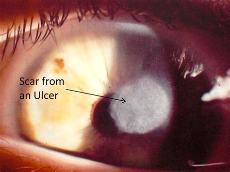 Corneal Ulcer