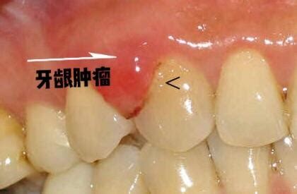 牙龈瘤初期图片 (37)_有来医生