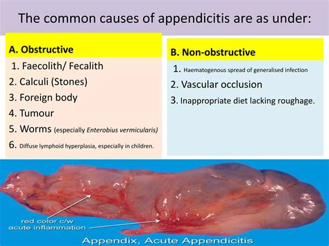 L acute appendicitis | PPTX