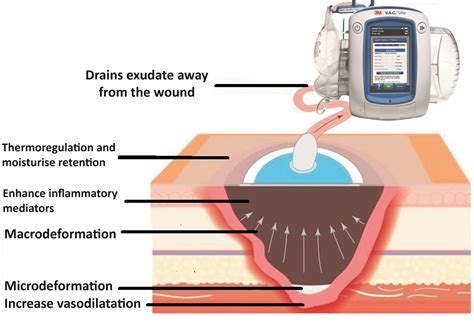 Negative Pressure Wound Therapy