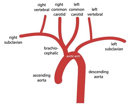 Common Origin of Brachiocephalic and Left Common Carotid Artery