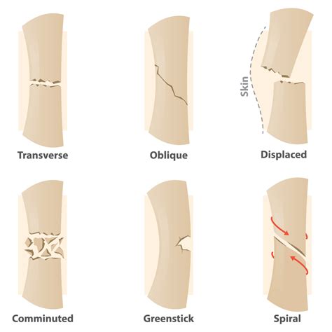 Bone Fractures