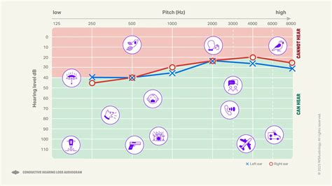 Conductive Hearing Loss Audiogram Example CONDUCTIVE HEARING LOSS
