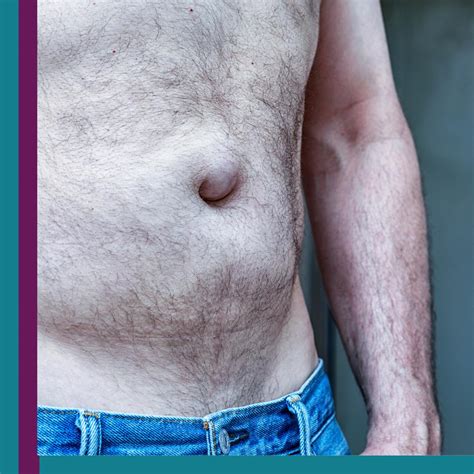 Fotos De Umbigo Com Hernia - FDPLEARN
