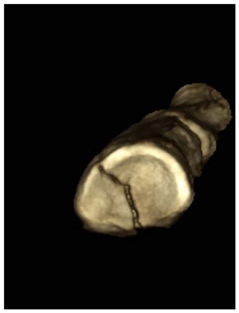 Pediatric Delayed Union in the Presence of WAGR Syndrome
