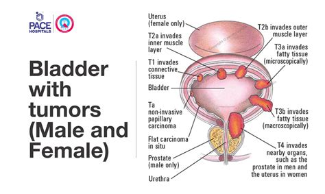 Transurethral Resection Of Bladder Tumor