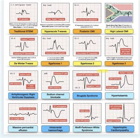 Basic ECG Rhythms 的图像结果