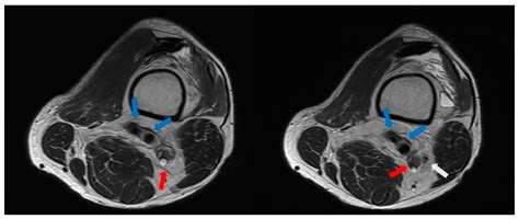 Palsy of Both the Tibial Nerve and Common Peroneal Nerve Caused by a ...