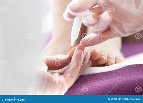Surgical Removal Of Pyogenic Granuloma On Skin Royalty-Free Stock Photography | CartoonDealer ...