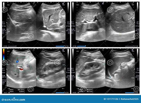 Ultrasound Upper Abdomen Showing Liver And Gall Bladder For Screening ...