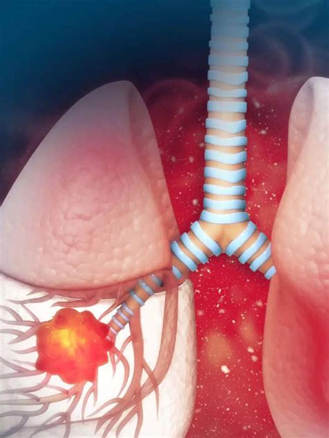ఊపిరితిత్తుల క్యాన్సర్‌కు కారణాలివే | TeluguSamayam