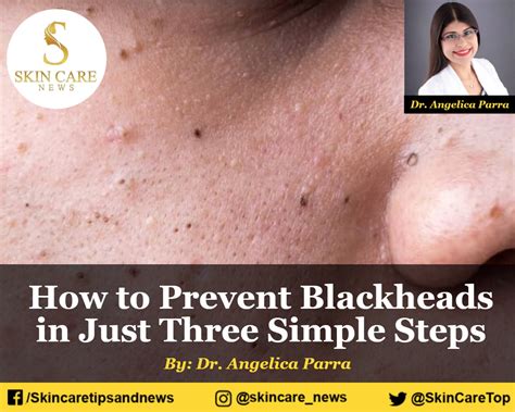 How to prevent blackheads in just three simple steps - how to prevent blackheads