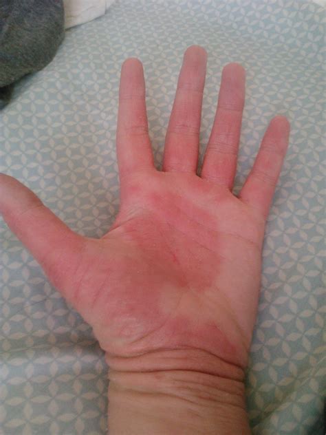 itchy rash on palms of hands - pictures, photos