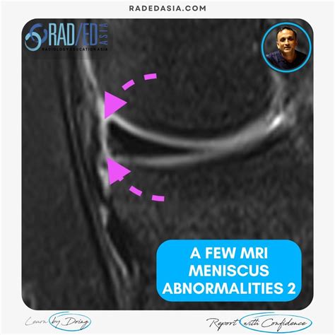 MENISCUS TEAR MACERATION DEGENERATION MRI KNEE RADIOLOGY (VIDEO) - Radedasia