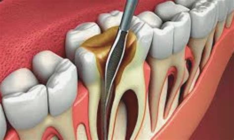 Larger apical preparation sizes may Raise Post-operative Pain during ...