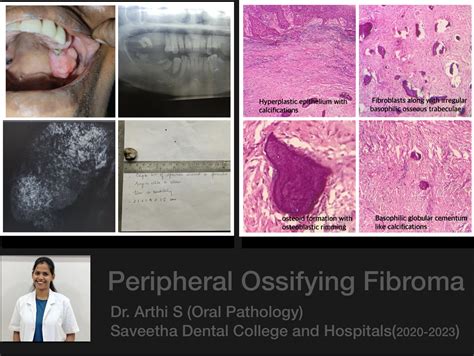 Ossifying Fibroma Oral