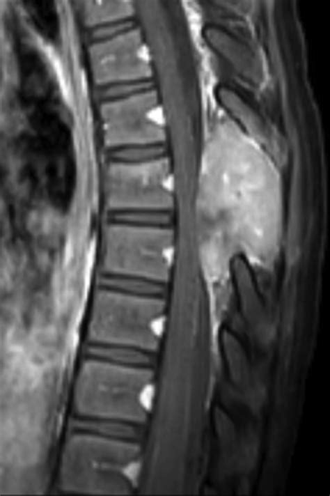 Spinal Giant Cell Tumor | Applied Radiology