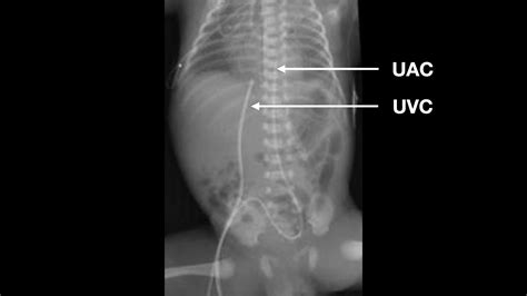 Neonatal lines and tubes - Don't Forget the Bubbles - should babies have x rays