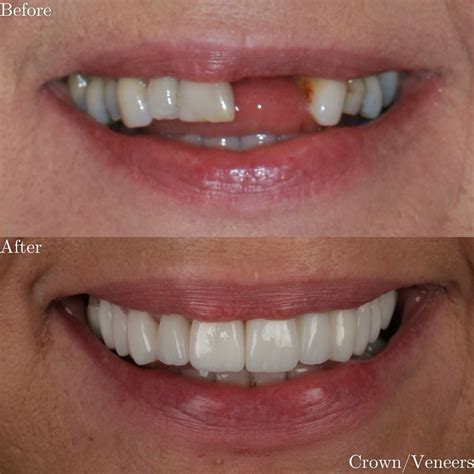 Crowns & Bridges - The Grange Dental and Implant Clinic