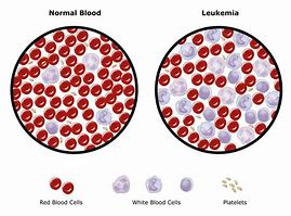 leukemia 的图像结果