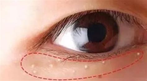 眼部周围的小颗粒真的是脂肪粒吗？ - 知乎