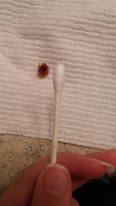 Just had this piece of impacted earwax come out of my ear...much relief ...