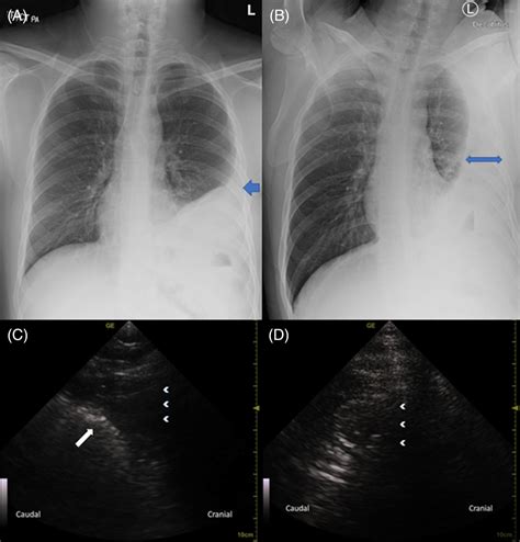 Bochdalek hernia masquerading as pleural effusion in a young adult ...