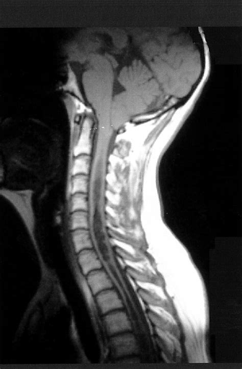 Arnold Chiari Malformation Type 2 Mri