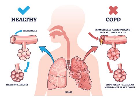 Better breathing: How we treat COPD