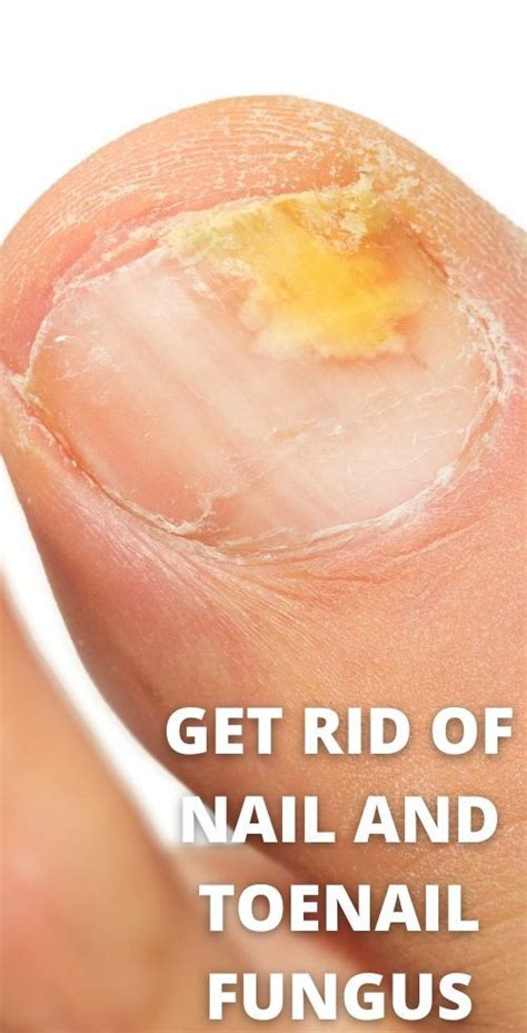 infection from ingrown toenail