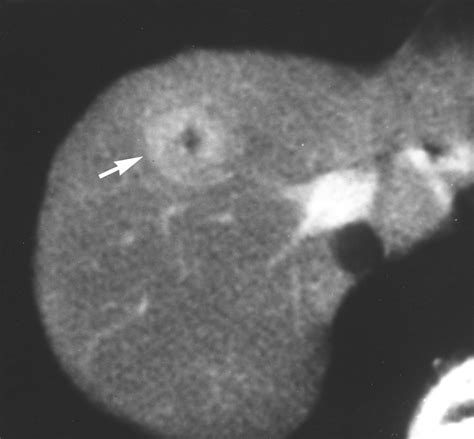 CT of Focal Nodular Hyperplasia of the Liver | AJR