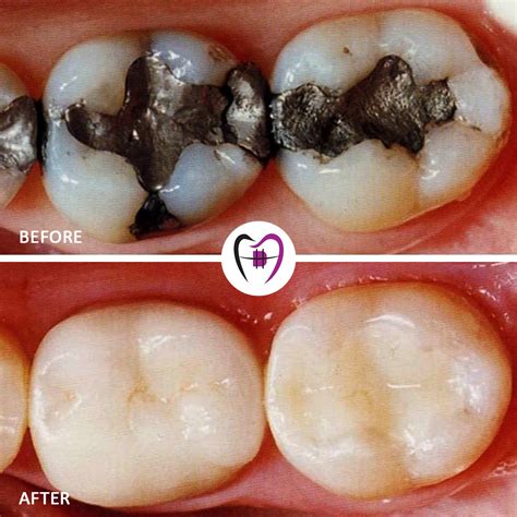 Dental Fillings: Types, Materials, Cost, Process, Side Effects