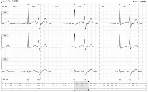 Image result for PVC Localization Chart