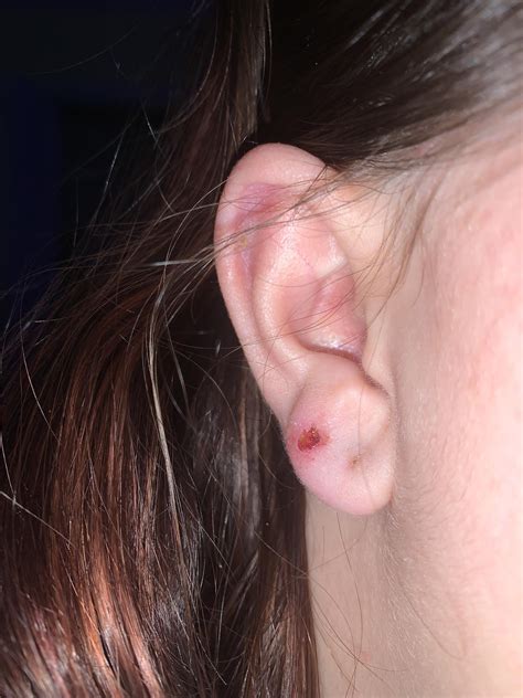 Infected Ear Piercing Hole Is My Piercing Infected Or Just Irritated?