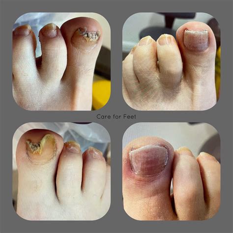 Toenail Fungus Before And After Say Goodbye To Toenail Fungus Quick