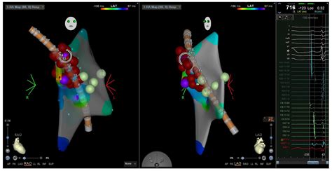 Electrophysiologic Considerations in Adult Patients with Ebstein’s Anomaly