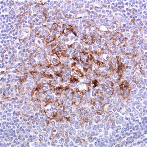 Prions in the Body and Creutzfeldt-Jakob Disease (CJD) | Owlcation