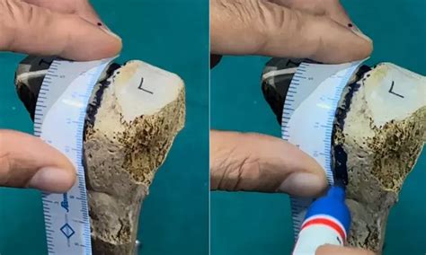 Mid-sulcus line predictive guide for tibial mechanical axis during TKA
