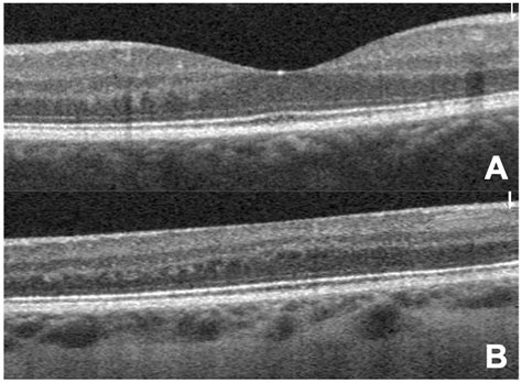 Characterizing Foveal Hypoplasia Using Optical Coherence Tomography ...
