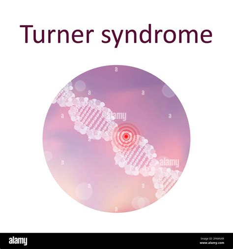 Turner syndrome, illustration Stock Photo - Alamy