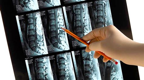 Herniated Disc Treatment | Florida Chiropractor | St. Petersburg, FL
