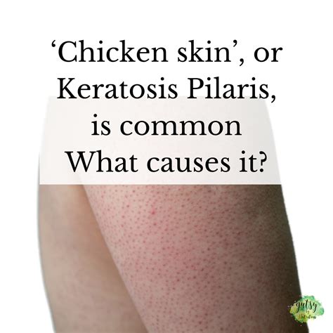 Keratosis Pilaris, or 'chicken skin', is common. What causes it? — Gutsy By Nutrition | Health ...