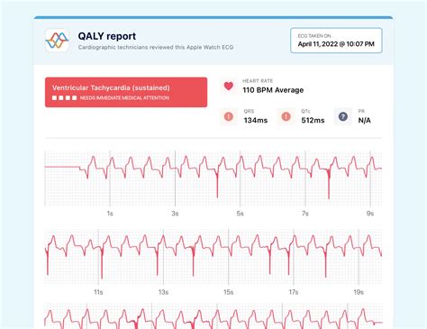 Calculating QT Interval: Expert Tips & Techniques | Qaly