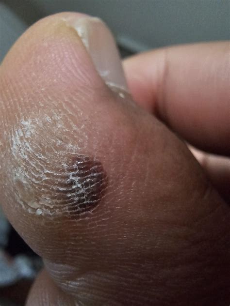 Strange mark on big toe (alongside callus) : r/Melanoma