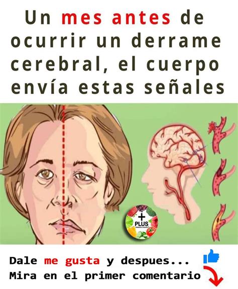 SEÑALES DE UN DERRAME CEREBRAL QUE DEBES PRESTAR ATENCIÓN