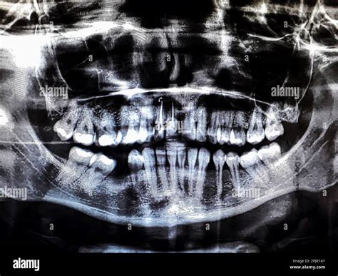 Panoramic dental tooth X-ray. Radiography for dental structures research concept Stock Photo - Alamy